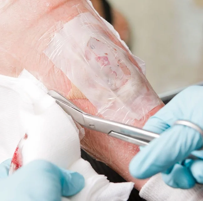 Close-up of a medical procedure where a healthcare professional is removing a blistered or burned skin bandage from a patient's arm with tweezers, wearing blue gloves.