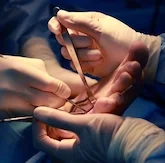 Surgeons performing an operation, with one surgeon holding surgical tools and another assisting.