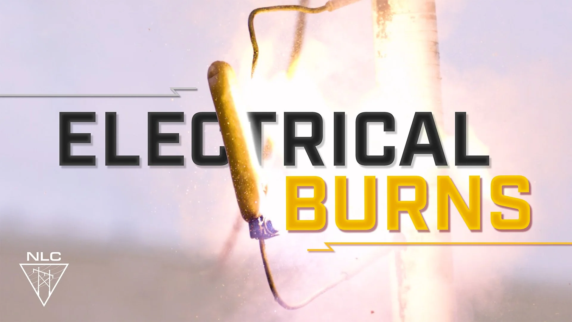 Electrical Burns