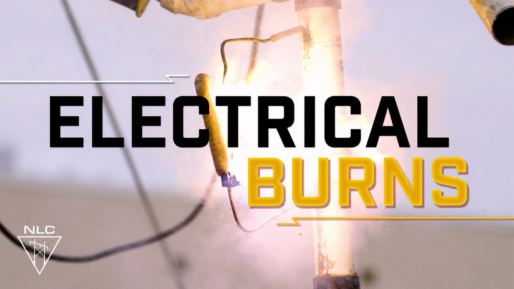 Electrical Burns