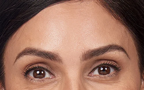 alexandra_front_forehead_after.jpg