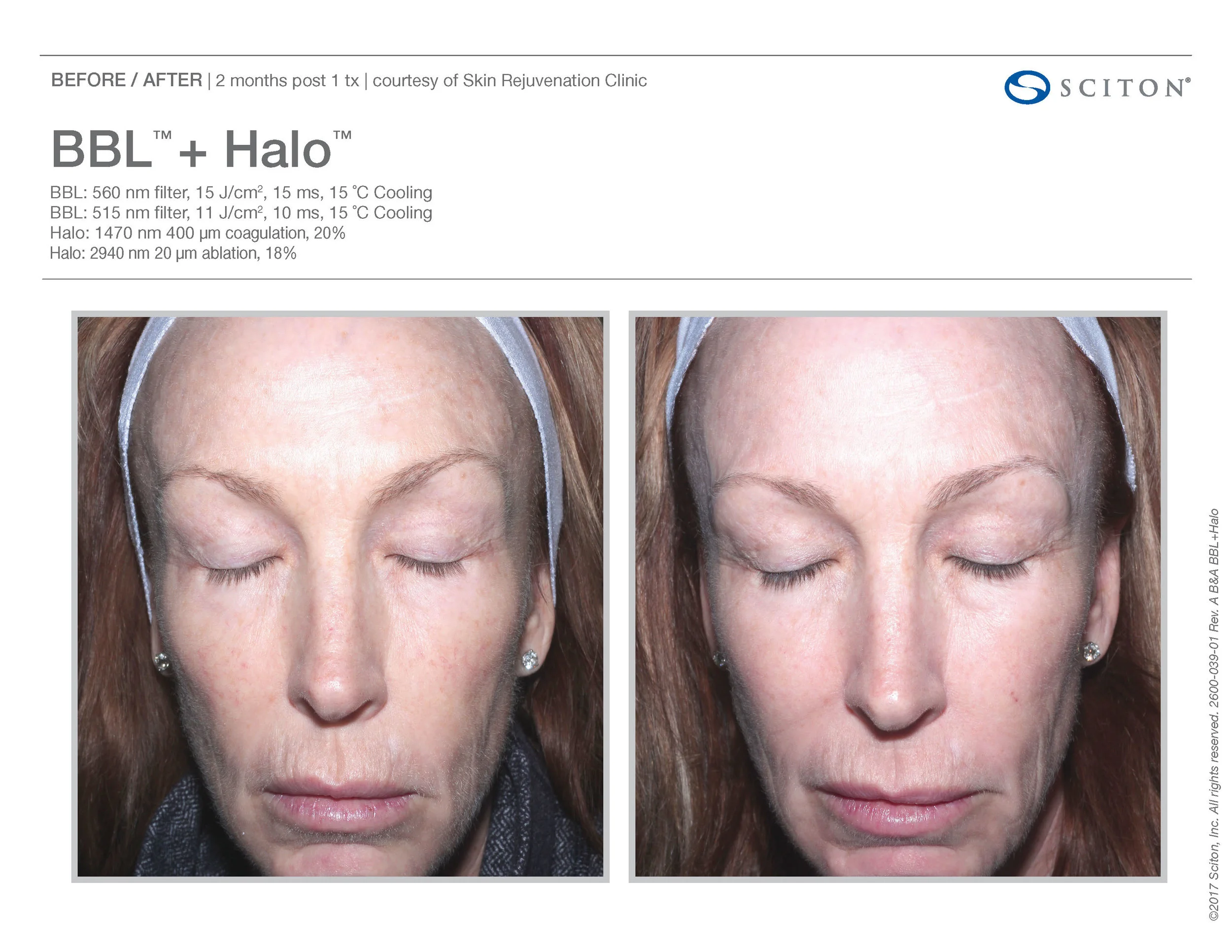 BBL+Halo B&A Nov'17_Page_07.jpg