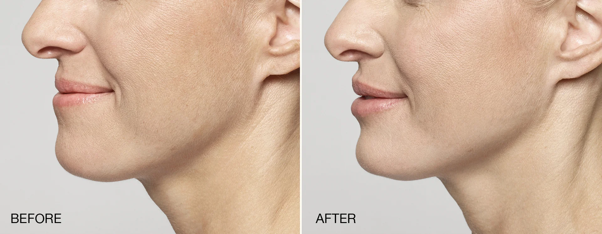 Restylane Silk Before + After
