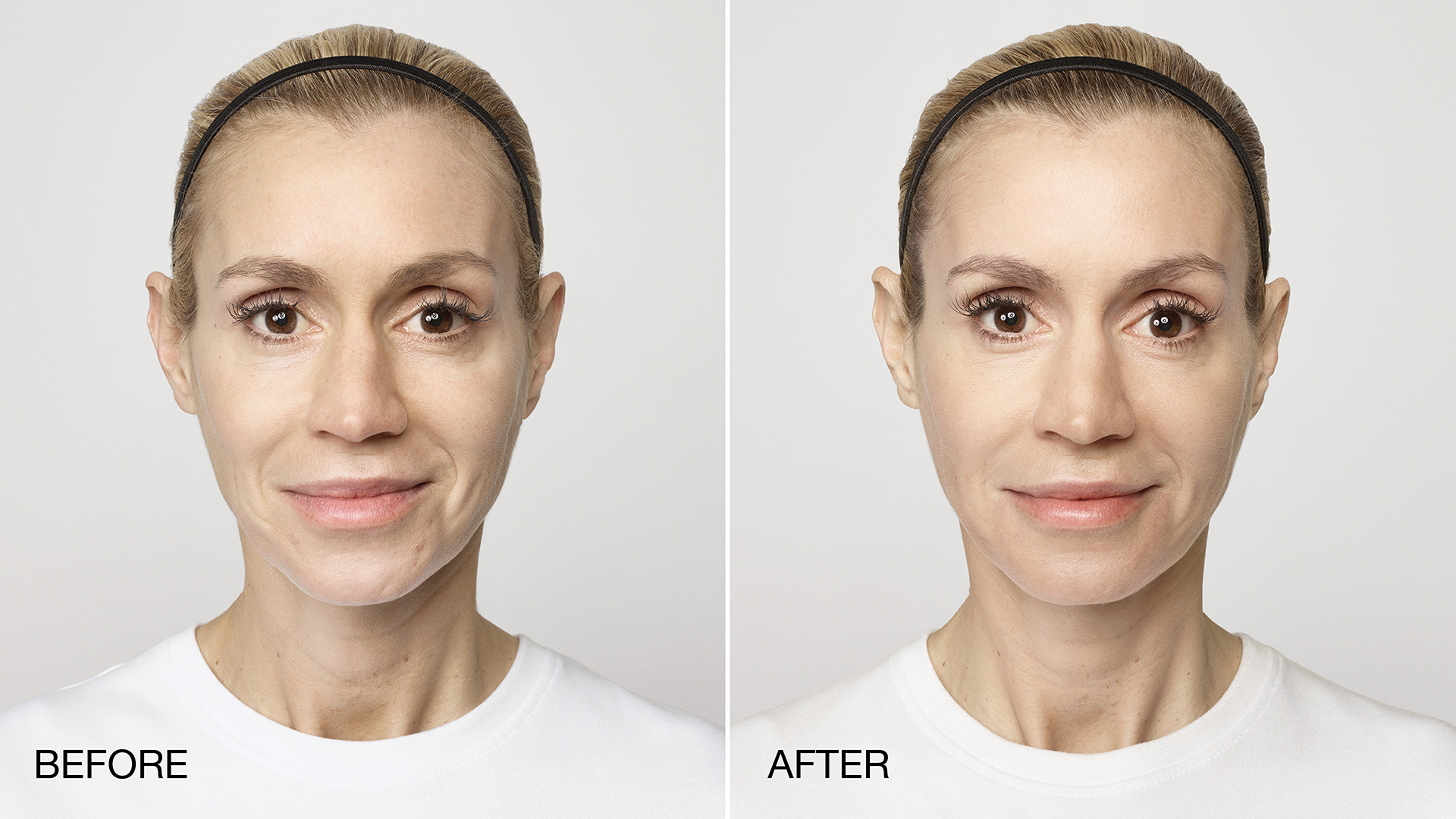 Restylane Silk Before + After
