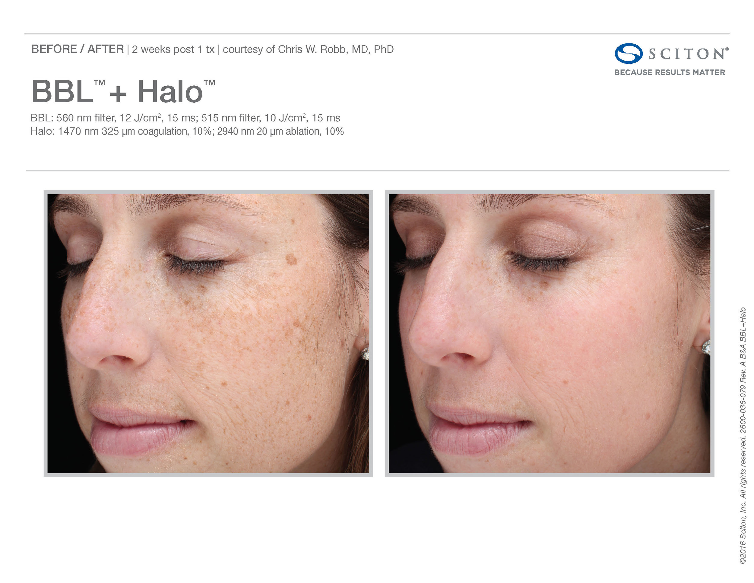 BBL+Halo B&A Nov'17_Page_02.jpg