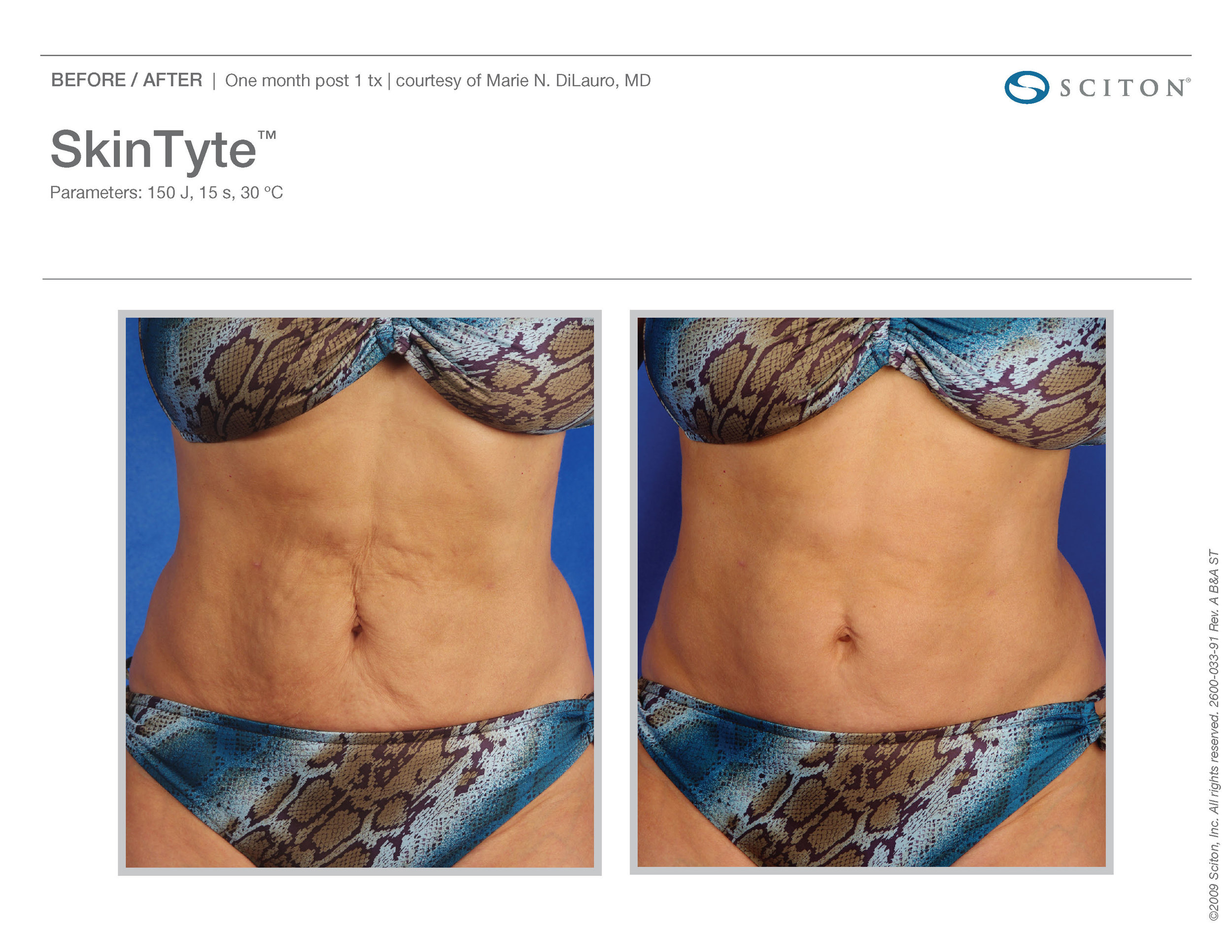 SkinTyte B&A Nov'17_Page_05.jpg