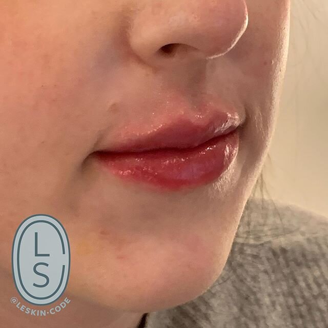 Angel lips 💋 using half a ml to hydrate and add subtle volume.
#cupidsbow #lipfiller #lips #balance #refine #refresh #hydration #leskincode