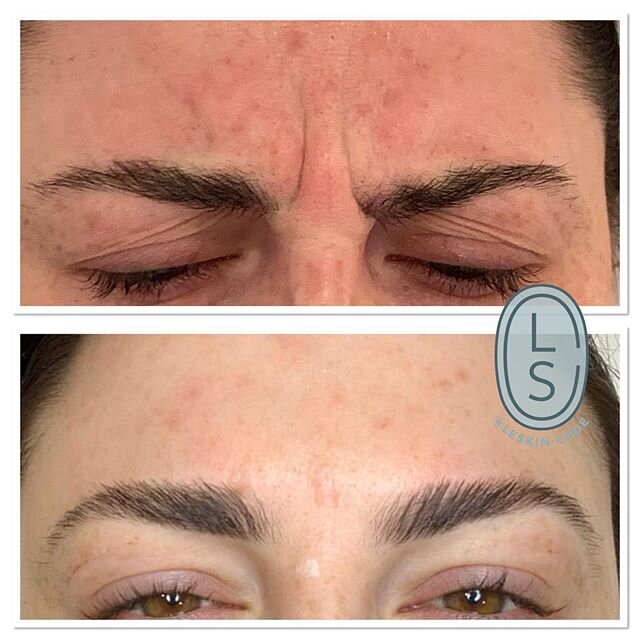 Anti-wrinkle treatment to frown, forehead and crows feet.
Photos taken two weeks a part. Love ❤️ love results. 
Moderate doses were prescribed to all three areas to achieve a smooth and wrinkle free result 💉💉💉
#antiaging #refresh #rejuvenate #refi