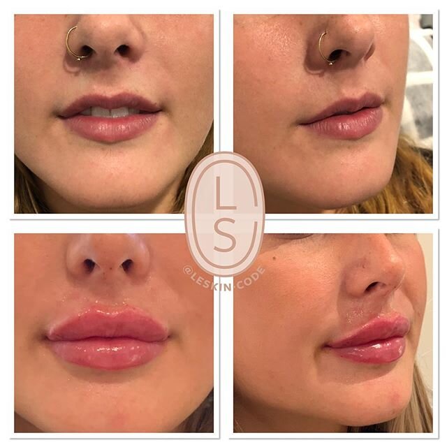 Lip filler can be a journey to get the result you want. This beautiful lady had her first lip filler treatment 2 years ago. After multiple treatments we have reached our goal!
Really loving the results for this beauty!
All result vary from client to 