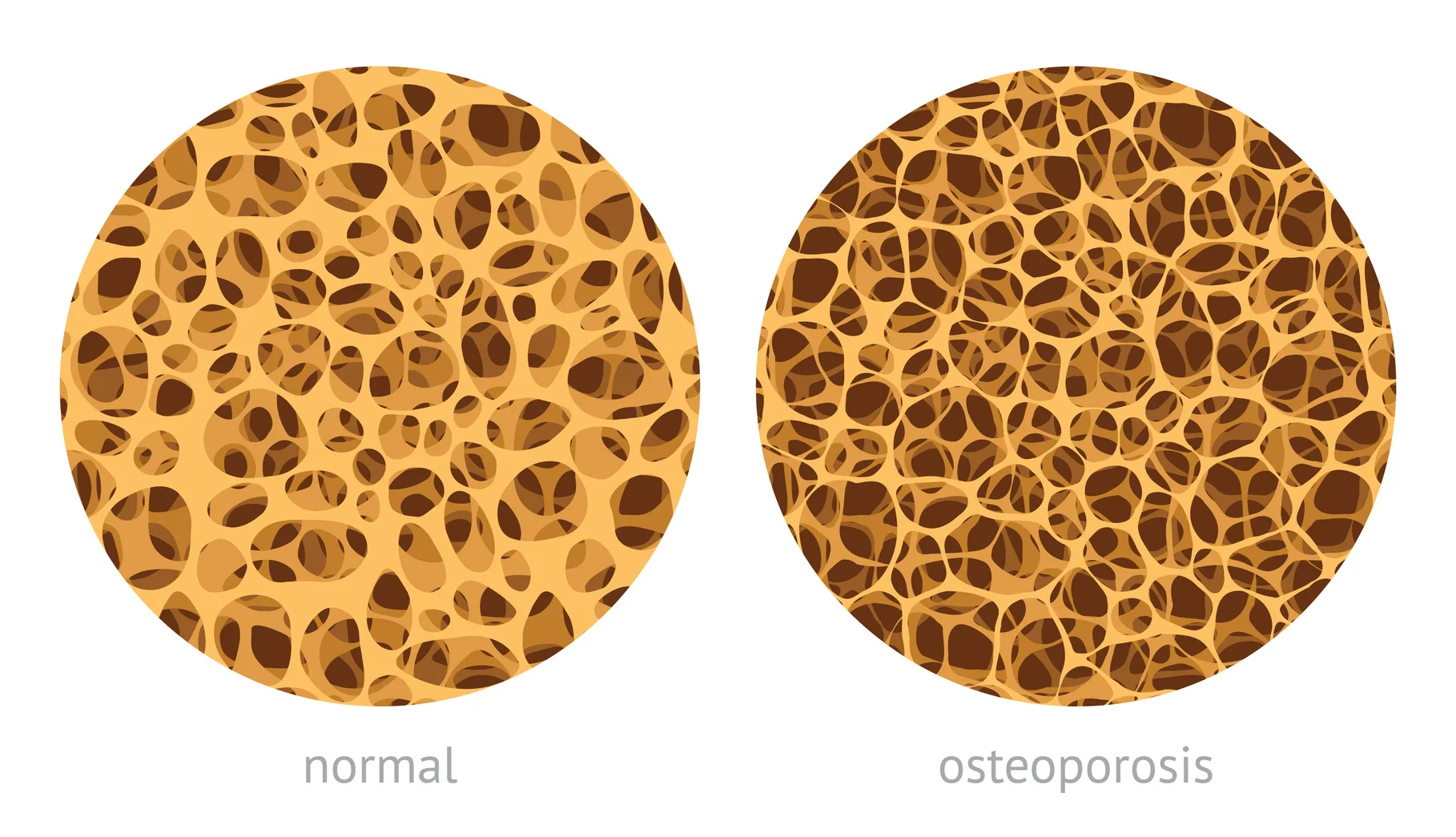Osteoporotic bone 1818.jpg