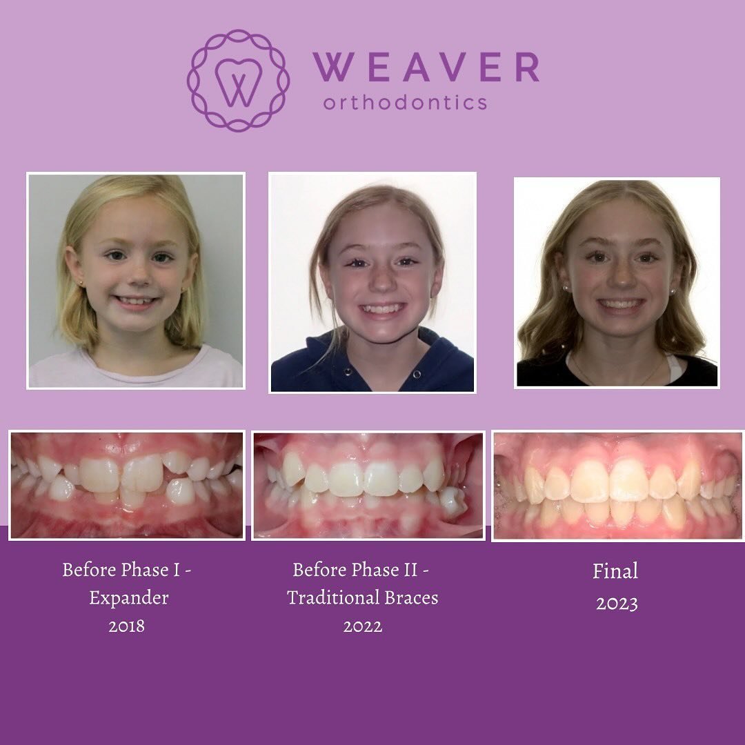 ☀️ Check out Ms. Paige&rsquo;s orthodontic treatment journey! Paige had a phase one of orthodontic treatment at age 7 to correct an anterior and posterior crossbite (the top teeth were stuck inside the bottom teeth). 🦷 We used a palate expander and 