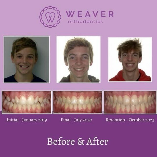 Check out this before and after - and after! ⏰Cameron finished treatment 3 years ago and has done a FANTASTIC job wearing his retainers! He presented in 2018 with a crossbite, upper and lower crowding and an end-on occlusion. 22 months of treatment u