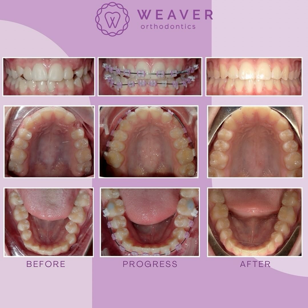 ✨ Transformation Tuesday! ✨This wonderful patient had Lightforce braces with elastics for 17 months in order to correct the crowding, crossbite and midline discrepancy. Now it&rsquo;s time for that #retainerlife! 😁 #smile #happy #braces #lightforceb