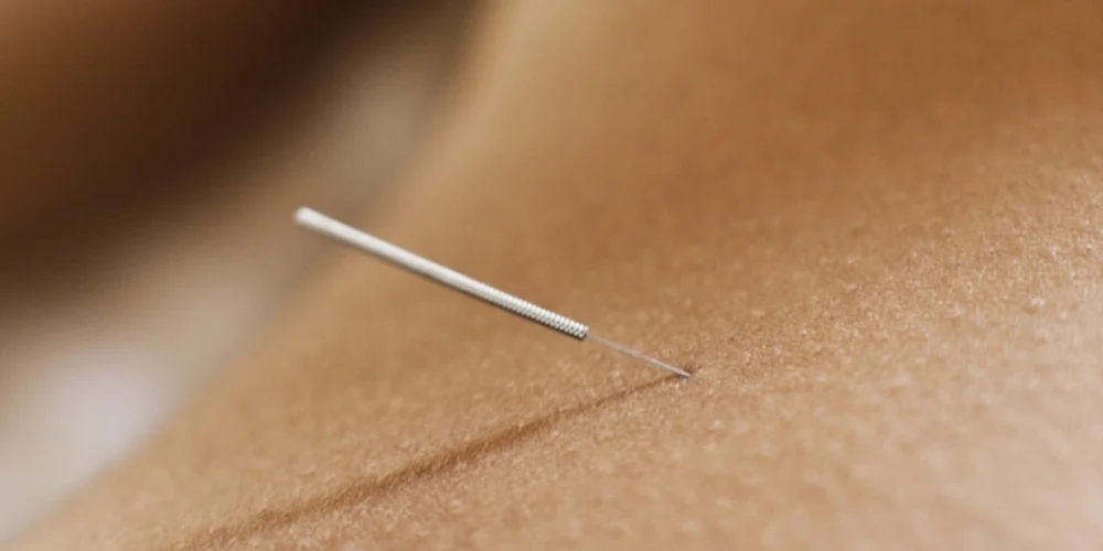 o-ACUPUNCTURE-NEEDLE-facebook.jpg