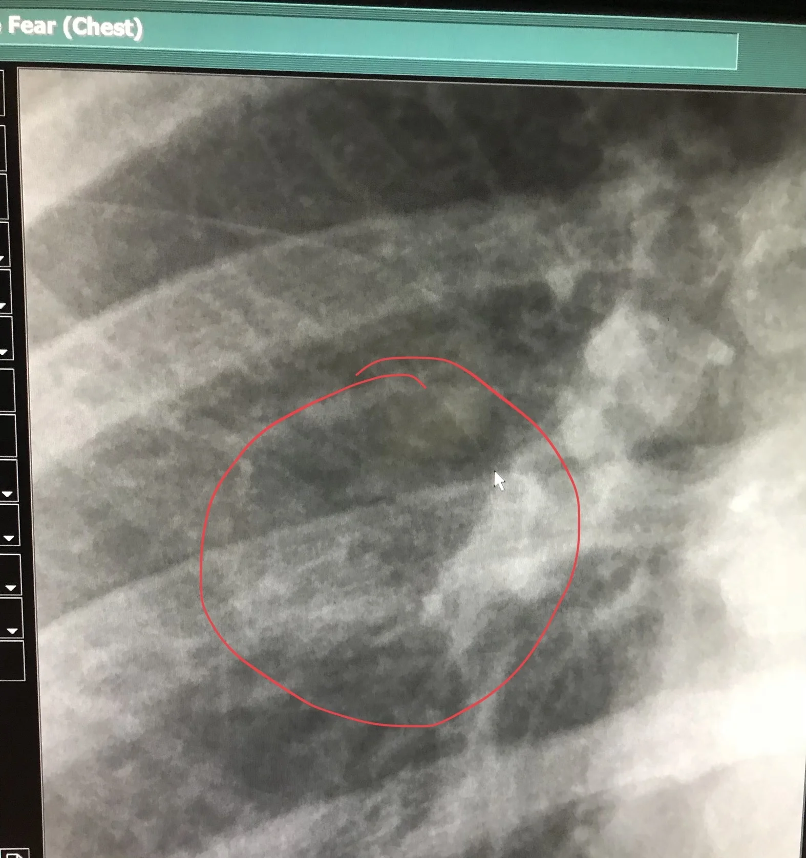 cracked ribs.jpg