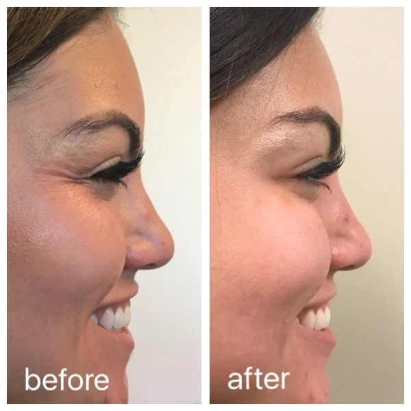 Botox to Crow's Feet