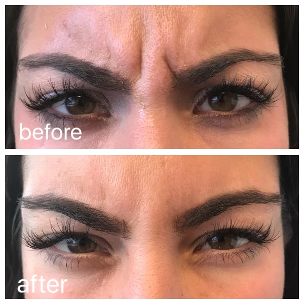Botox to Forehead
