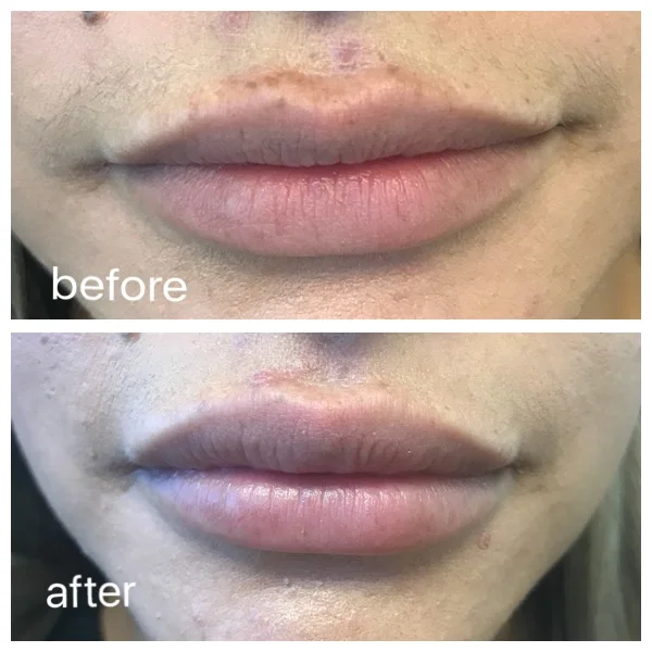 Lip Filler