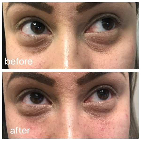 Undereye Filler