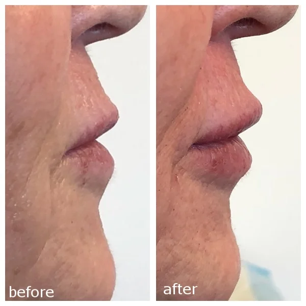 Lip Fillers