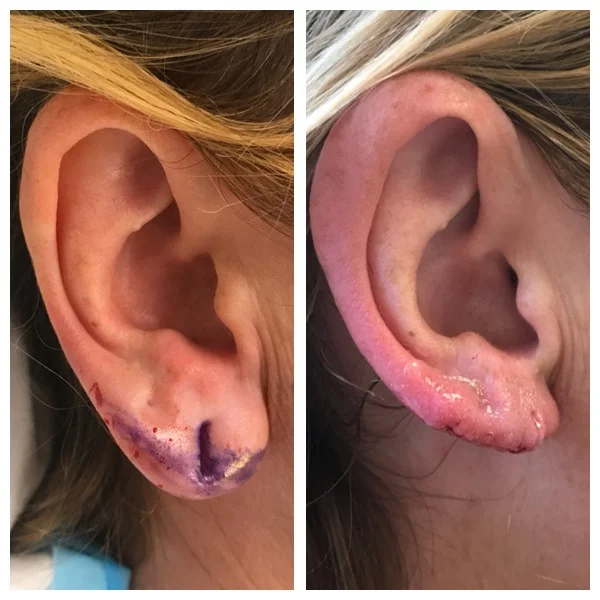 Earlobe Reduction