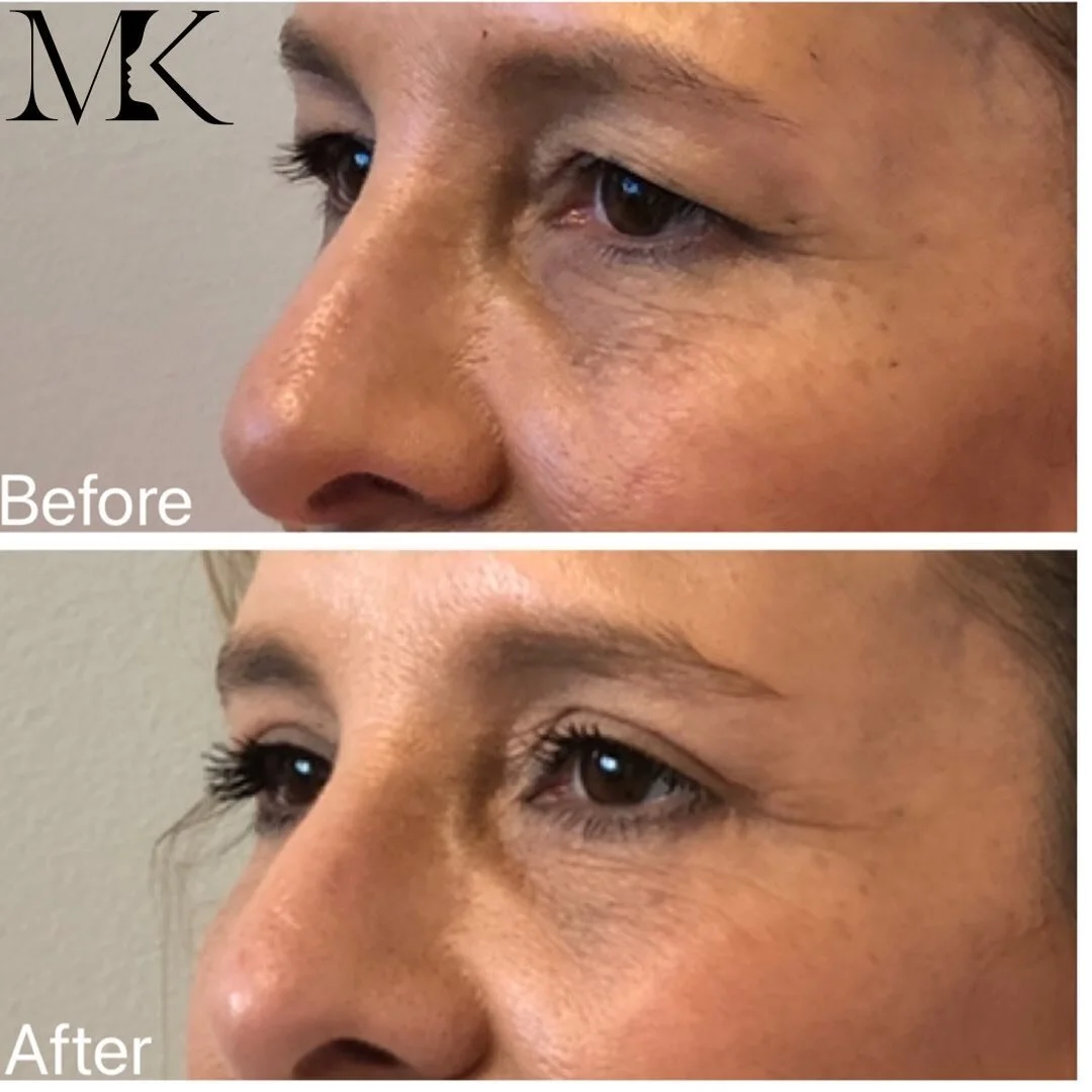 👁Upper blepharoplasty (eyelid lift) 👁  I LOVE performing this surgery because it creates such a dramatic impact!  My patient is a special education teacher and was looking for a little refresh without a significant downtime, and without looking lik
