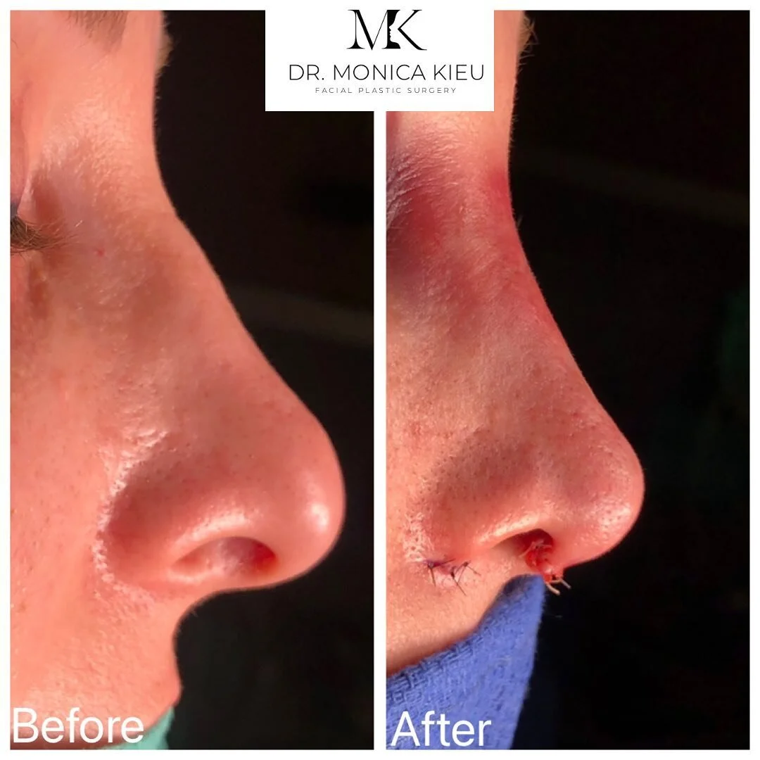So grateful this lovely patient trusted me with her revision rhinoplasty - her previous surgery left her with some contour irregularities and a round, droopy tip.  It wasn&rsquo;t a straightforward procedure, there was quite a bit of scar tissue and 