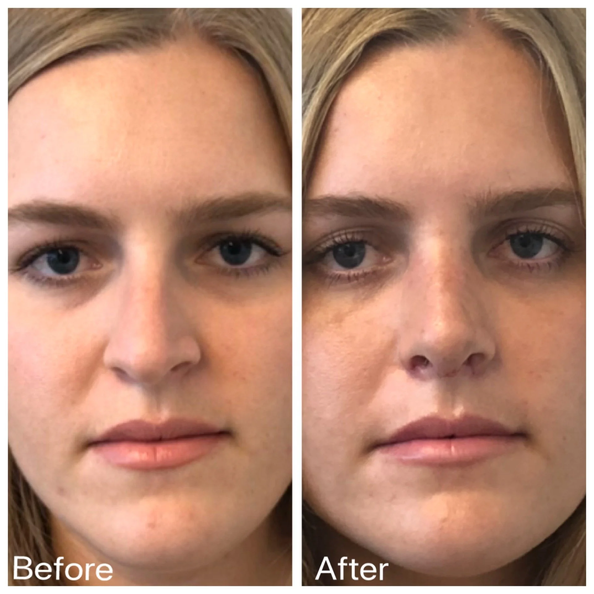 Rhinoplasty Recovery: A Week-by-Week Timeline (What I Tell Every Patient)