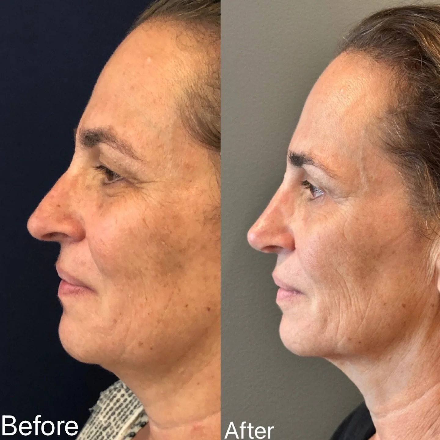 ⭐️ Long-term rhinoplasty and upper bleph results ✨

I had the absolute pleasure of seeing my lovely patient over 2 years out from her rhinoplasty and upper blepharoplasty procedure.  Our goals were clear and simple: add subtle refinement while stayin