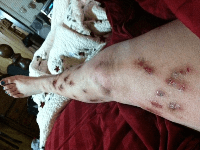 BCA-Morgellons.png