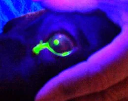 The same eye with Fluoroscein stain under a woods lamp now clearly shows the damaged corneal surface (a central corneal ulcer)
