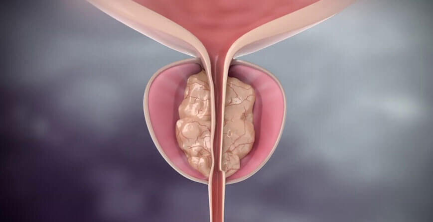 Hogyan lehet elkerülni a kiújuló prosztatagyulladást, a Proposta farmaci per la prostata ingrossata