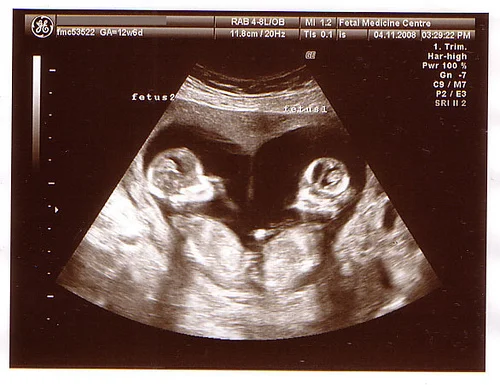 heart-shaped-sono-twins.jpg