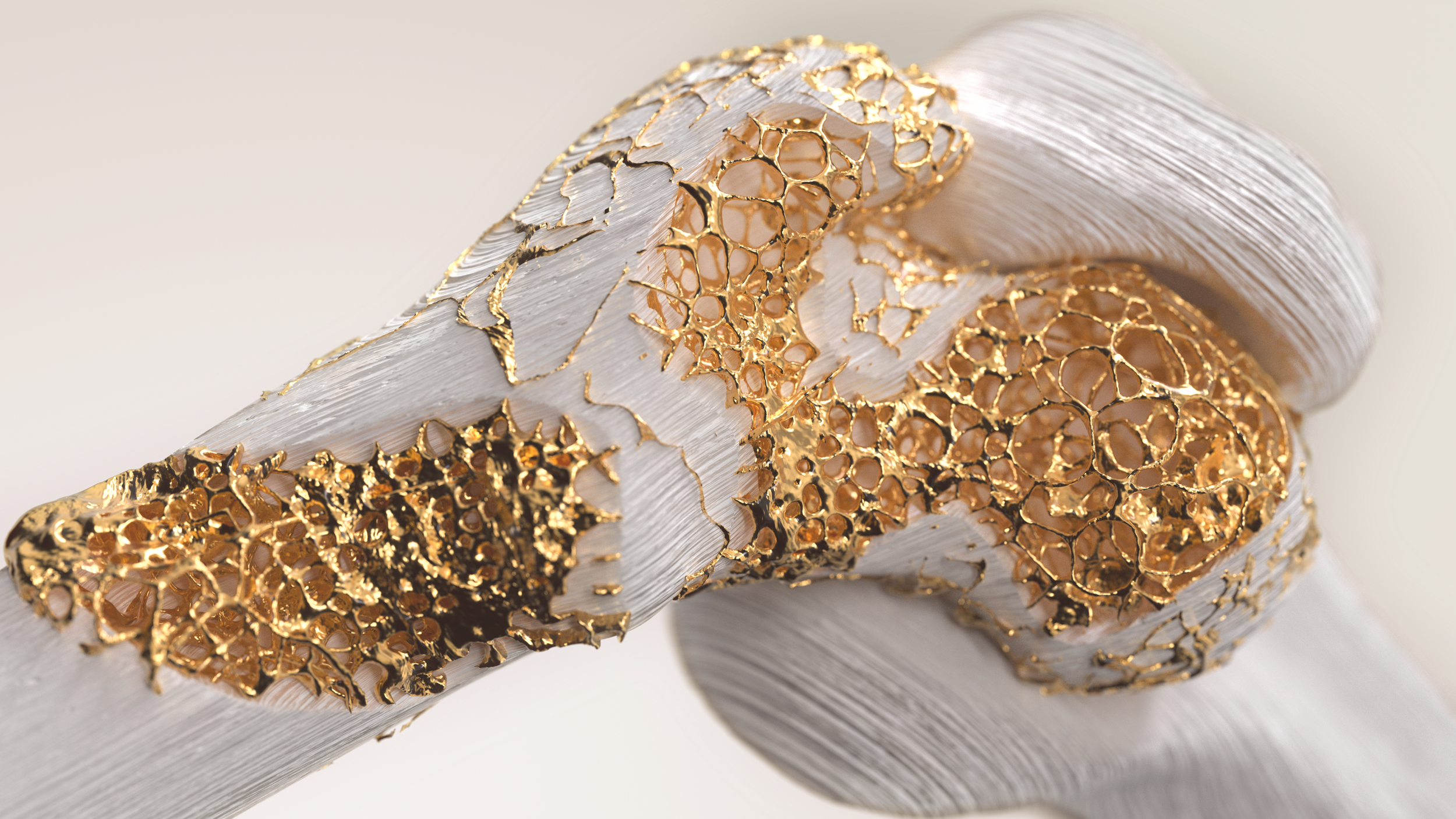 Multiple_myeloma_v01 (0-00-00-00).png