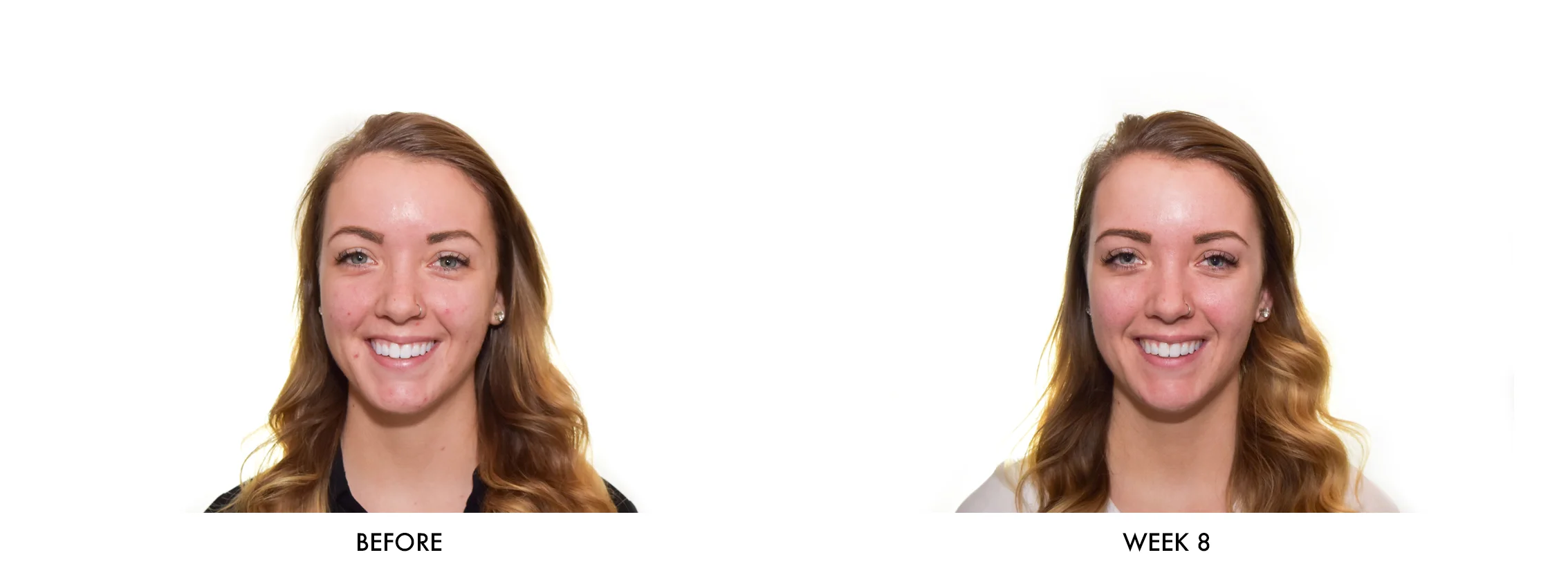 LED Bluelight Photofacial Before and After.jpg