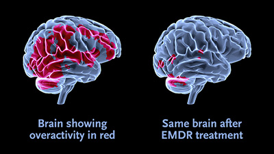 EMDR-web-illustration-brain.jpg