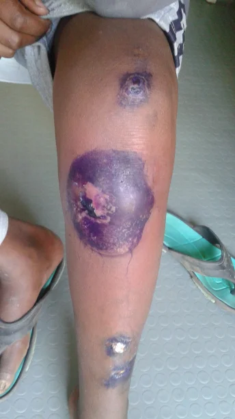 leg-wound1-june-spotlight.jpg