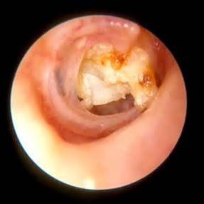 cholesteatoma nov. case.jpg