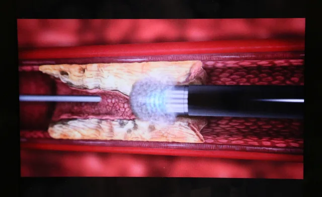 our laser vaporizing plaque molecules to the size of a red blood cell