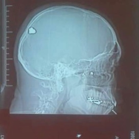 A hospital x-ray of Mario's skull, 2006