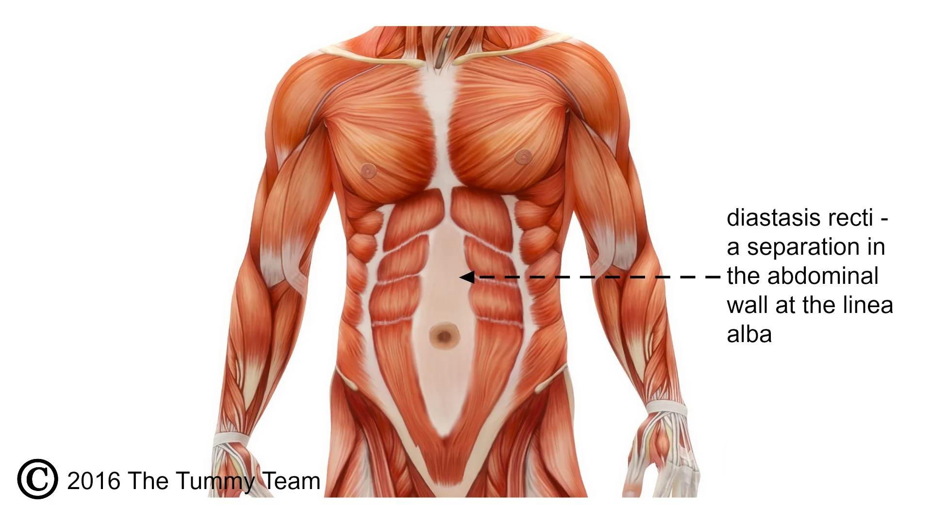 diastasis-diagram.jpg