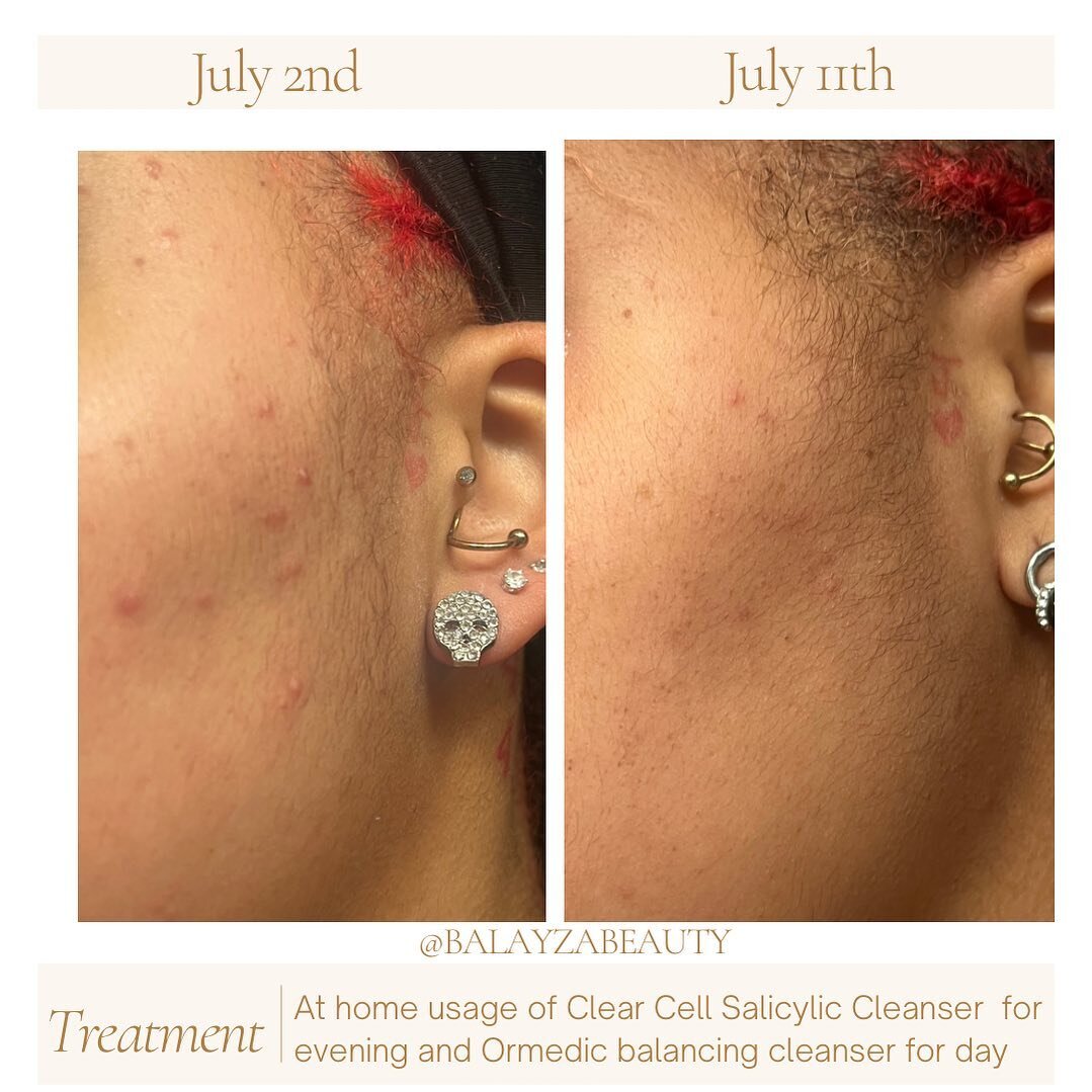 Check out this 9 day difference on the side of the cheek from laying on a dirty pillowcase! 

💡What was done?
Well obviously the change in the pillowcase was step one 😂 Step 2 was to gather the products that was going to fix it! 

💡Product super s