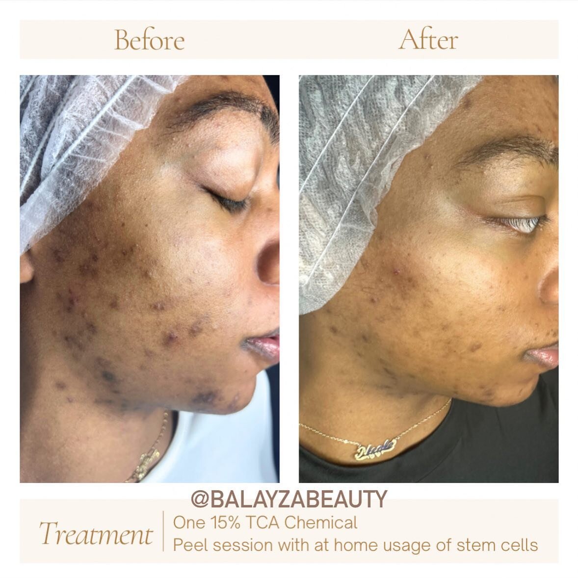 Hyperpigmentation can run as deep into your dermis (second layer of skin) which is why treatments such as peels are ideal to help lift and fade it out.

💡Hyperpigmentation are one of the hardest conditions to fade/rid which is why products are also 