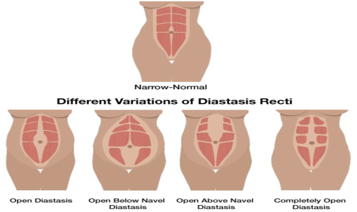 Diastasis Recti treatment NJ  Treat Diastasis Recti at the