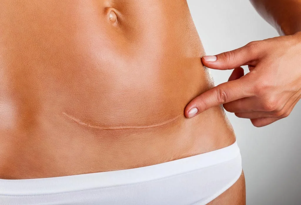 Scar Tissue and Adhesion Treatment