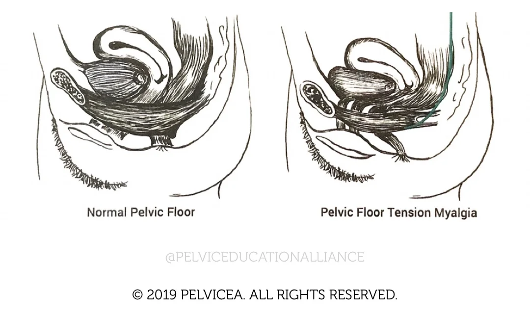Where Is Your Pain Really Coming From Uncovering The Pelvic Floor