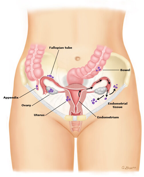 Endometriosis Symptoms & Treatment — There is Hope