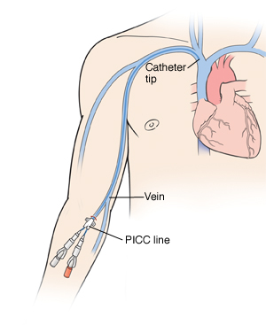 PICC Catheter Install