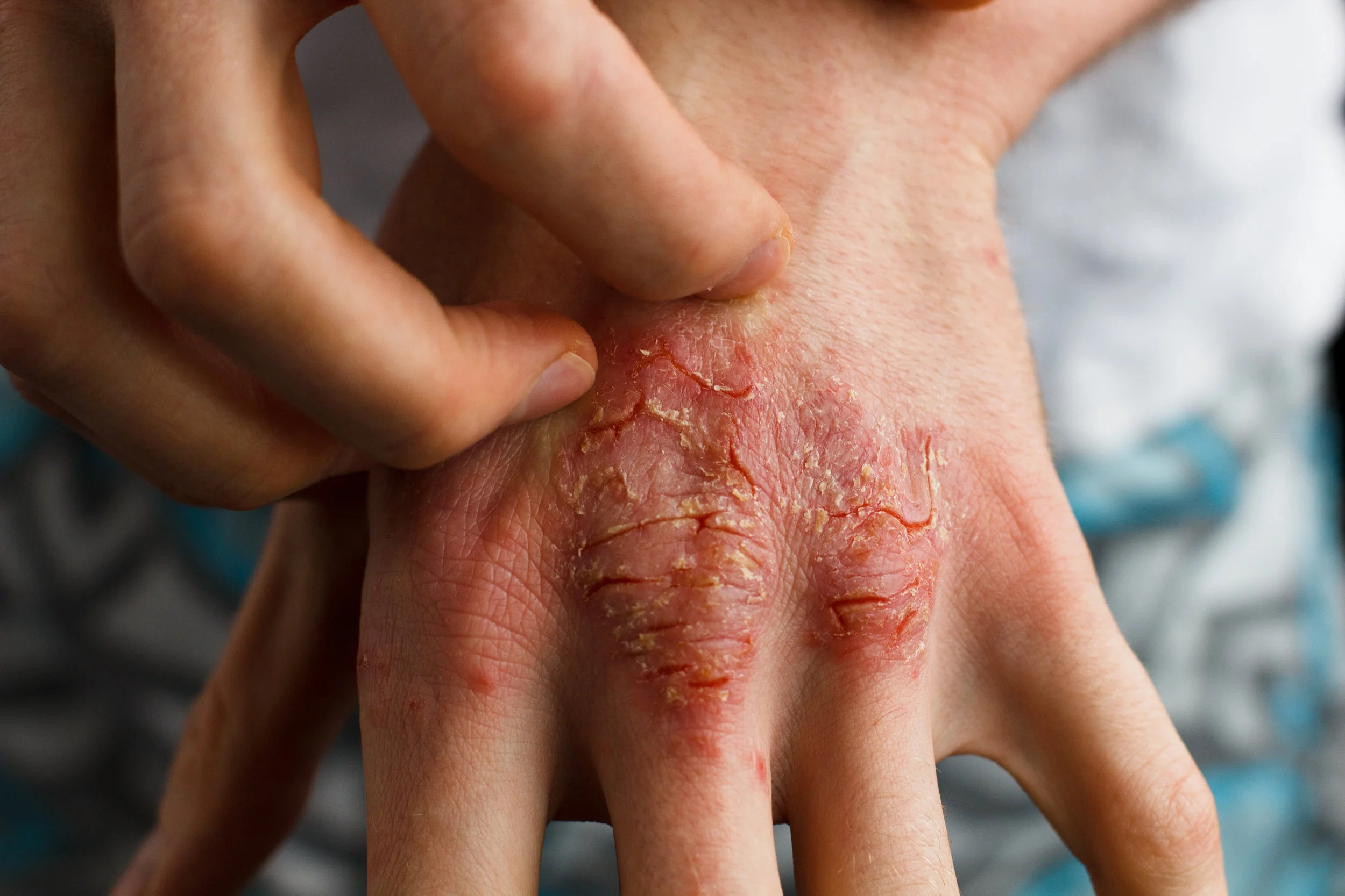 Eczema right Pic _137059687.jpeg