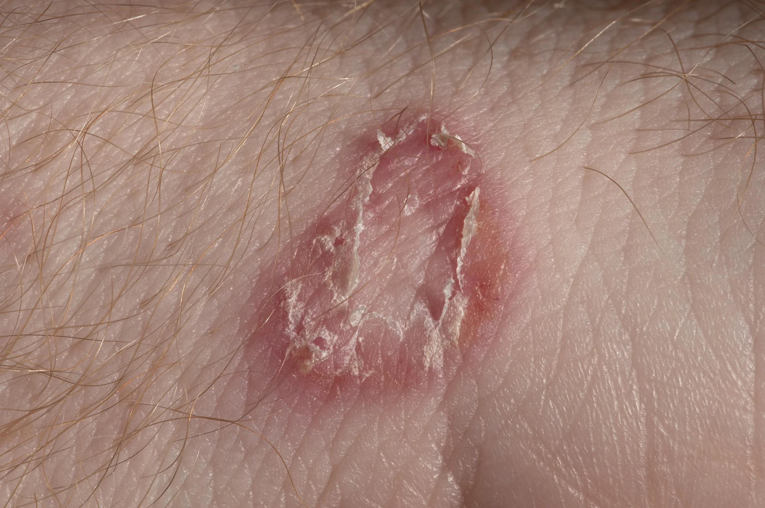 Fungal Infections bottom_104749637.jpeg
